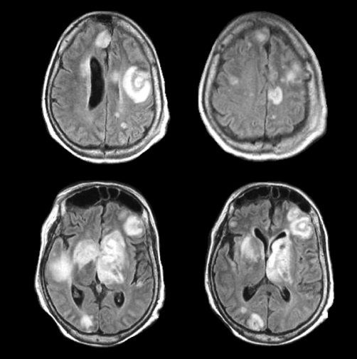 metastatic-disease-late